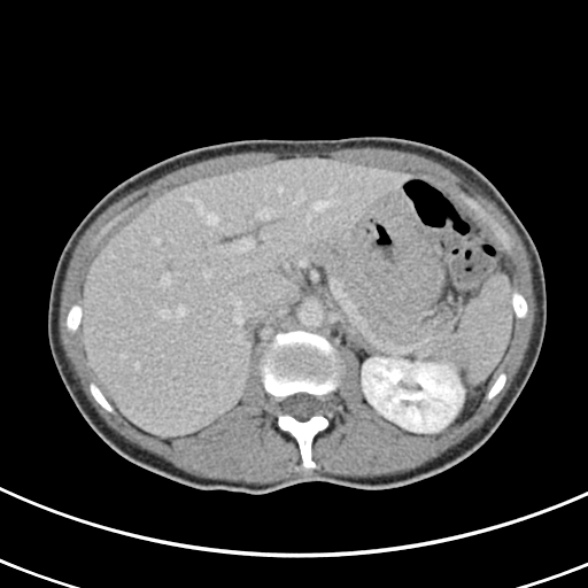 File:Normal multiphase CT liver (Radiopaedia 38026-39996 C 21).jpg