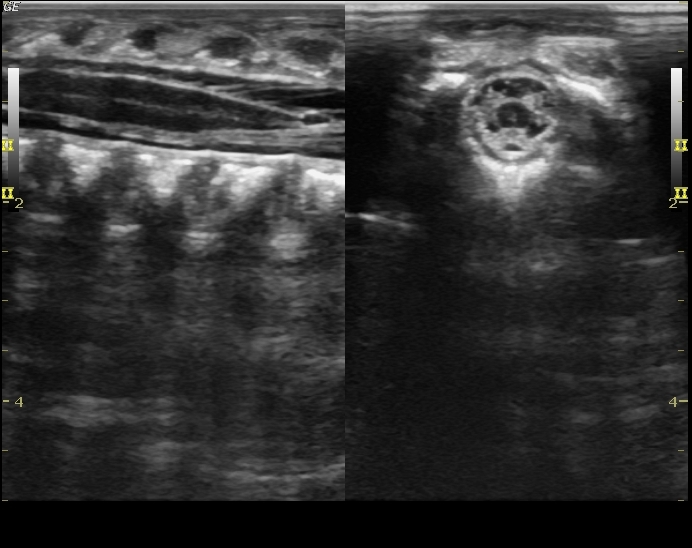 File:Normal neonatal spinal canal on ultrasound (Radiopaedia 34886-36353 B 1).jpg