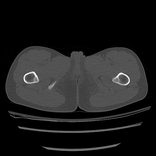 Normal pelvis CT (Radiopaedia 51471-57236 Axial bone window 104).jpg
