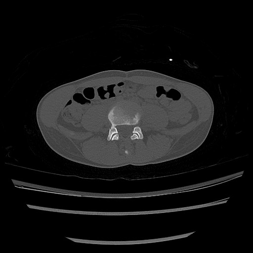 Normal pelvis CT (Radiopaedia 51471-57236 Axial bone window 3).jpg