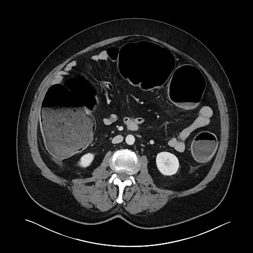 File:Obstructing sigmoid adenocarcinoma (Radiopaedia 58465-65619 A 82).jpg