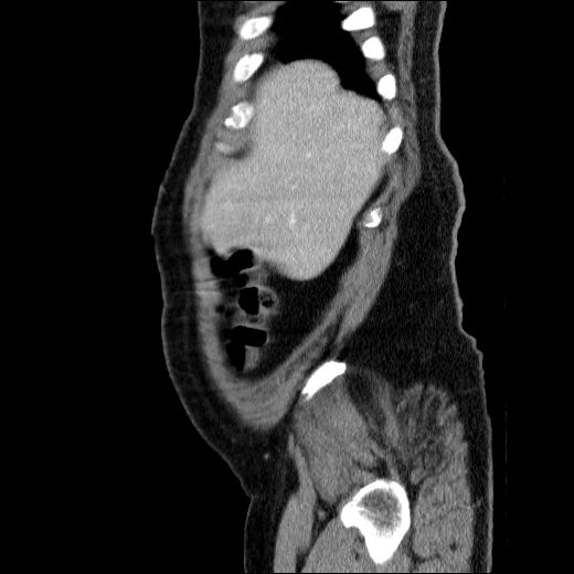 Obstructing ureteric calculus (Radiopaedia 49281-54373 C 77).jpg