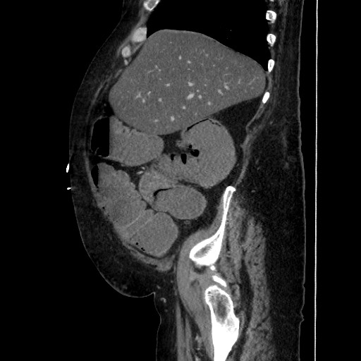 Obstructive colonic diverticular stricture (Radiopaedia 81085-94675 C 67).jpg