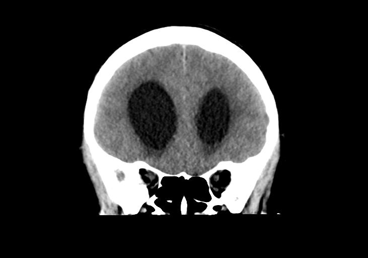 File:Obstructive hydrocephalus (Radiopaedia 30453-31119 Coronal non-contrast 12).jpg