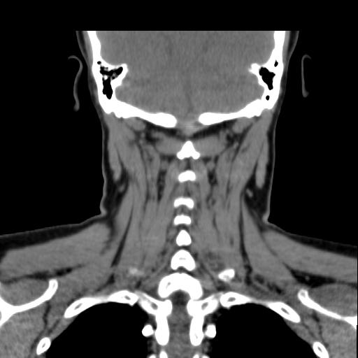 File:Obstructive sleep apnea (CT evaluation) (Radiopaedia 24304-24582 Coronal non-contrast 77).jpg