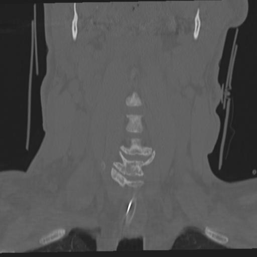 File:Occipital condyle fracture (Radiopaedia 33467-34517 Coronal bone window 18).png