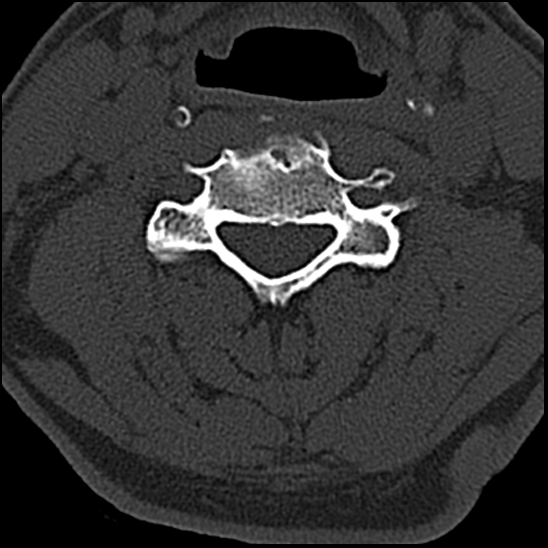 Occipital condyle fracture (type 1) (Radiopaedia 87670-104084 Axial bone window 47).jpg