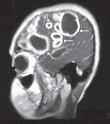 Cranial MRI revealed multiple, contrast-dense masses -abscesses