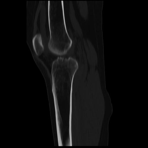 File:ACL avulsion fracture (Radiopaedia 33833-34994 Sagittal bone window 21).jpg