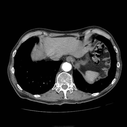 Abdominal aortic aneurysm (Radiopaedia 13341-13340 Axial C+ arterial phase 17).jpg