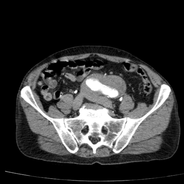 Abdominal aortic aneurysm (Radiopaedia 29248-29660 Axial C+ arterial phase 64).jpg