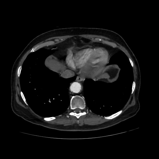 File:Abdominal aortic aneurysm (Radiopaedia 57318-64259 Axial C+ arterial phase 5).jpg