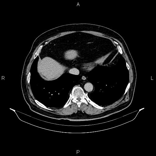 Abdominal aortic aneurysm (Radiopaedia 83094-97462 Axial renal excretory phase 13).jpg