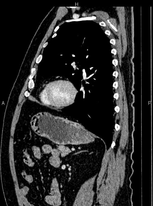 Abdominal aortic aneurysm (Radiopaedia 83094-97462 Sagittal renal cortical phase 84).jpg