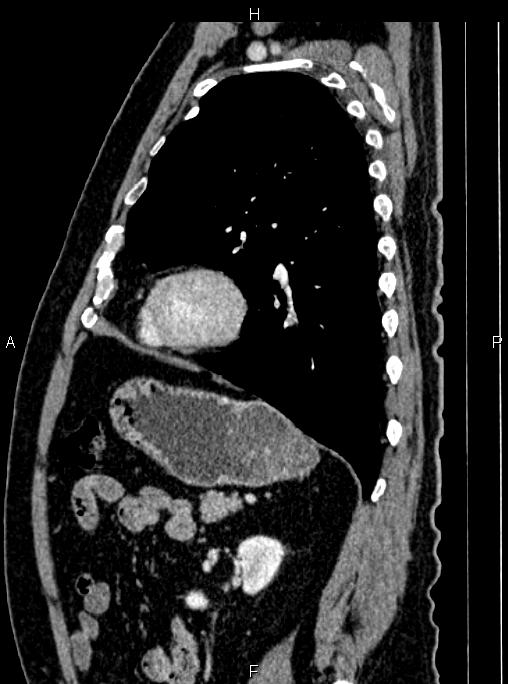 Abdominal aortic aneurysm (Radiopaedia 83094-97462 Sagittal renal cortical phase 87).jpg