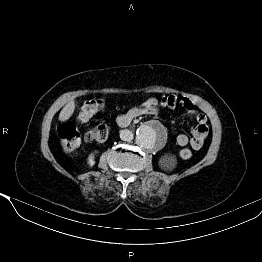 File:Abdominal aortic aneurysm (Radiopaedia 85063-100606 Axial C+ delayed 57).jpg