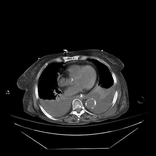 Abdominal aortic aneurysm - impending rupture (Radiopaedia 19233-19247 Axial non-contrast 16).jpg