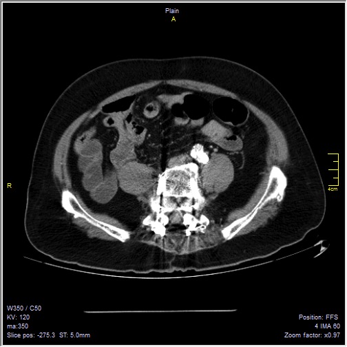 Abdominal aortic aneurysm with thrombus fissuration (Radiopaedia 47340-51926 Axial C+ arterial phase 44).jpg