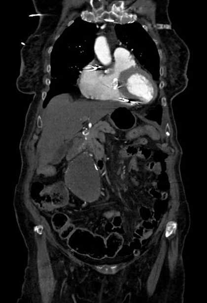 Abdominal aortic aneurysm with thrombus fissuration (Radiopaedia 73192-83919 Coronal C+ arterial phase 17).jpg