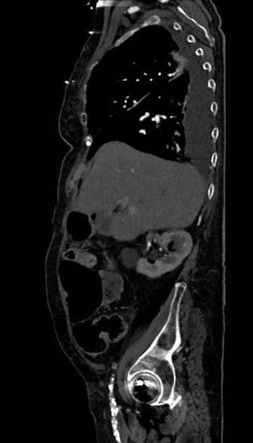 Abdominal aortic aneurysm with thrombus fissuration (Radiopaedia 73192-83919 Sagittal C+ arterial phase 105).jpg