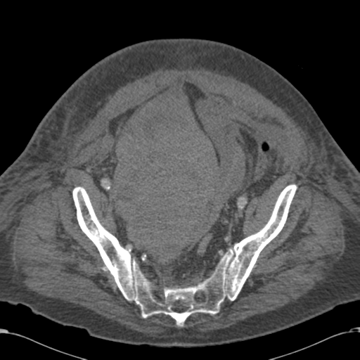 Abdominal hematoma (Radiopaedia 33614-34715 Axial C+ portal venous phase 107).png