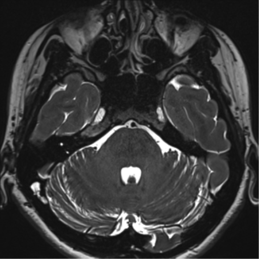 Abducens nerve palsy (Radiopaedia 51069-56648 Axial T2 fat sat 31).png
