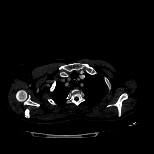 File:Accesory rib joint (Radiopaedia 71987-82452 Axial bone window 84).jpg