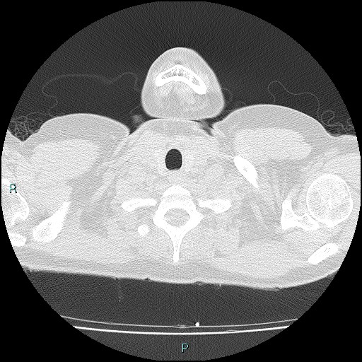 File:Accidental foreign body aspiration (seamstress needle) (Radiopaedia 77740-89983 Axial lung window 3).jpg