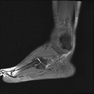 File:Achilles tendon tear (Radiopaedia 77615-89819 Sagittal PD fat sat 21).jpg