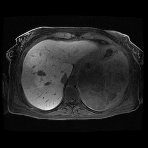 Acinar cell carcinoma of the pancreas (Radiopaedia 75442-86668 Axial late phase (~30 mins) 111).jpg