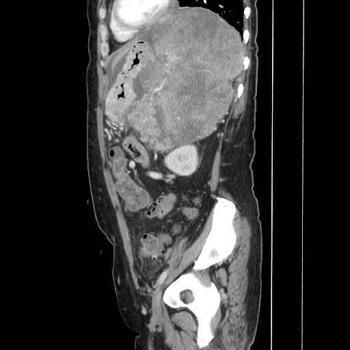 Acinar cell carcinoma of the pancreas (Radiopaedia 75442-86669 Sagittal C+ portal venous phase 134).jpg
