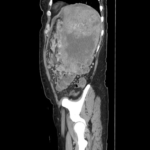 Acinar cell carcinoma of the pancreas (Radiopaedia 75442-86669 Sagittal C+ portal venous phase 152).jpg