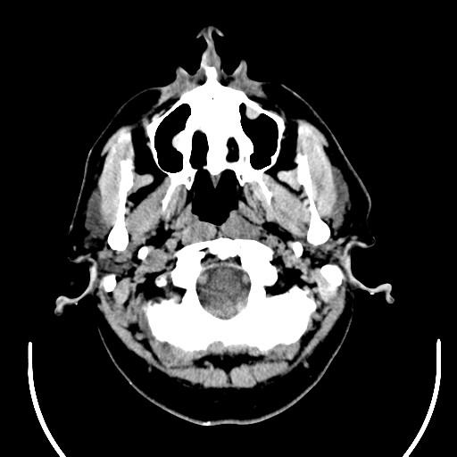 File:Acoustic schwannoma (Radiopaedia 39170-41388 Axial non-contrast 3).png