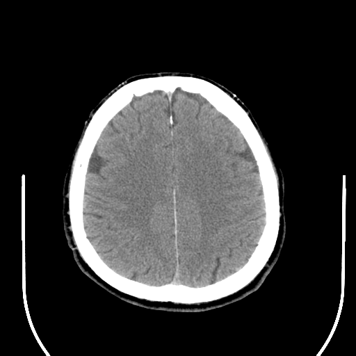 File:Acoustic schwannoma (Radiopaedia 39170-41388 Axial non-contrast 37).png