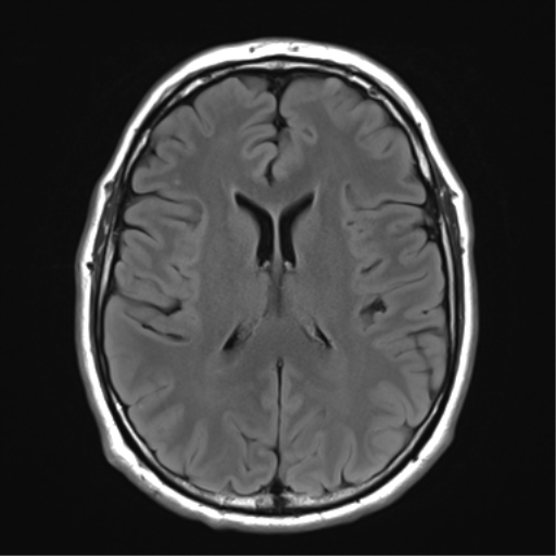 File:Acoustic schwannoma (Radiopaedia 50846-56358 Axial FLAIR 19).png