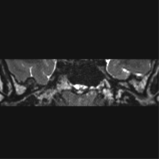 File:Acoustic schwannoma (Radiopaedia 50846-56358 Coronal T2 37).png