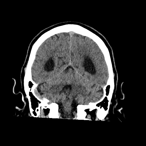 File:Acoustic schwannoma (Radiopaedia 55729-62280 Coronal non-contrast 30).png