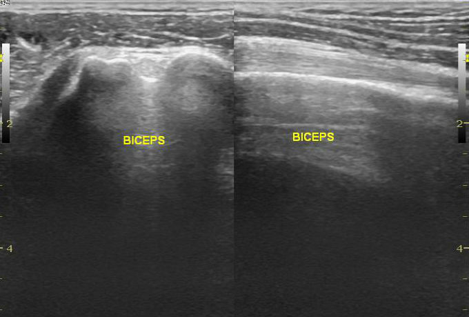 File:Acromial fracture - ultrasound (Radiopaedia 26729-26891 C 1).jpg