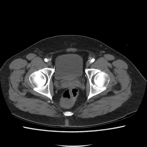 File:Active colonic bleed on CT (Radiopaedia 49765-55025 Axial C+ arterial phase 78).jpg