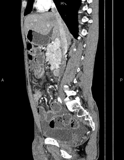 Active crohn disease (Radiopaedia 87133-103397 Sagittal C+ arterial phase 37).jpg