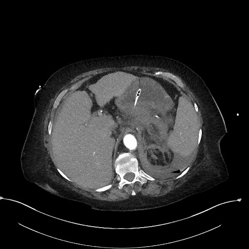 File:Active renal extravasation with large subcapsular and retroperitoneal hemorrhage (Radiopaedia 60975-68796 Axial C+ arterial phase 46).jpg