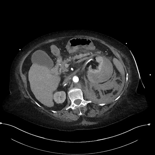 Active renal extravasation with large subcapsular and retroperitoneal hemorrhage (Radiopaedia 60975-68796 Axial C+ arterial phase 71).jpg