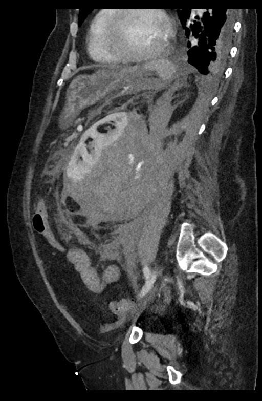 Active renal extravasation with large subcapsular and retroperitoneal hemorrhage (Radiopaedia 60975-68796 Sagittal C+ portal venous phase 89).jpg