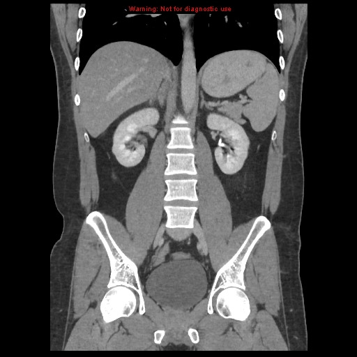 File:Acute appendicitis (Radiopaedia 10498-10973 F 27).jpg