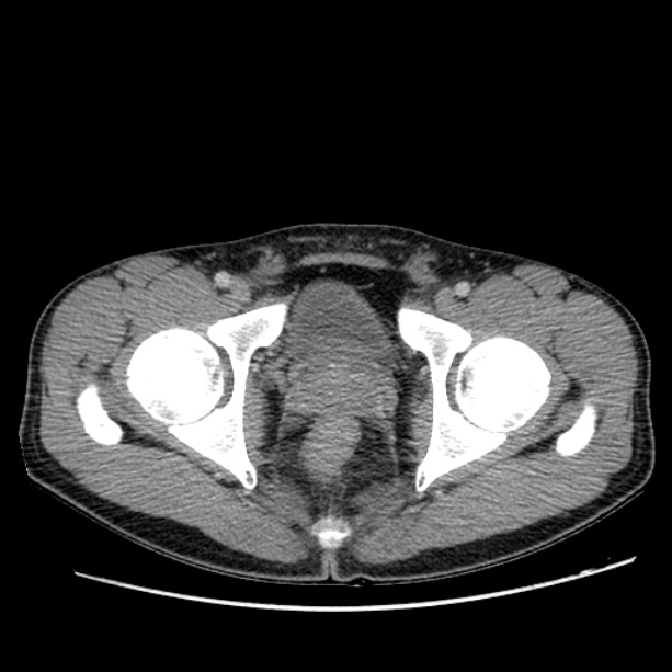 Acute appendicitis (Radiopaedia 27049-27227 Axial C+ portal venous phase 74).jpg