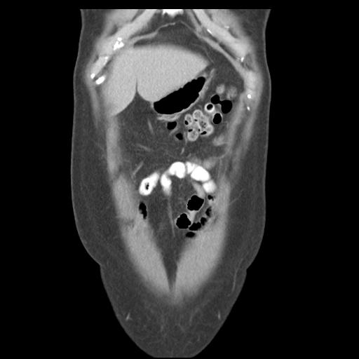 Acute appendicitis (Radiopaedia 30297-30934 Coronal C+ portal venous phase 8).jpg