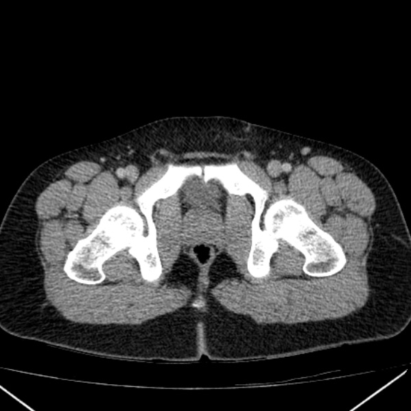 Acute appendicitis (Radiopaedia 38255-40270 Axial C+ portal venous phase 112).jpg
