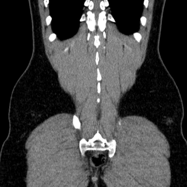 Acute appendicitis (Radiopaedia 38255-40270 Coronal C+ portal venous phase 77).jpg