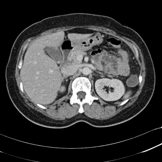 File:Acute appendicitis (Radiopaedia 48792-53822 Axial C+ portal venous phase 36).jpg
