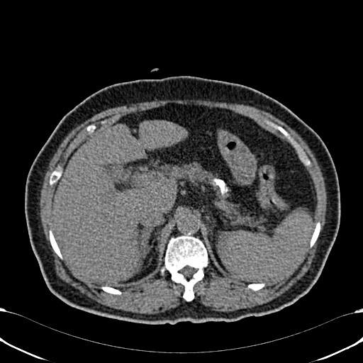 Acute appendicitis (Radiopaedia 58627-65818 Axial non-contrast 24).jpg